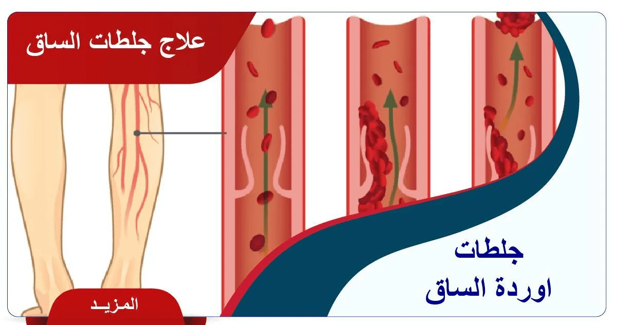 علاج جلطات اوردة الساقين